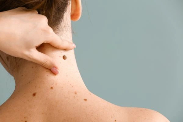 skin blemish removal Dumfries treatment