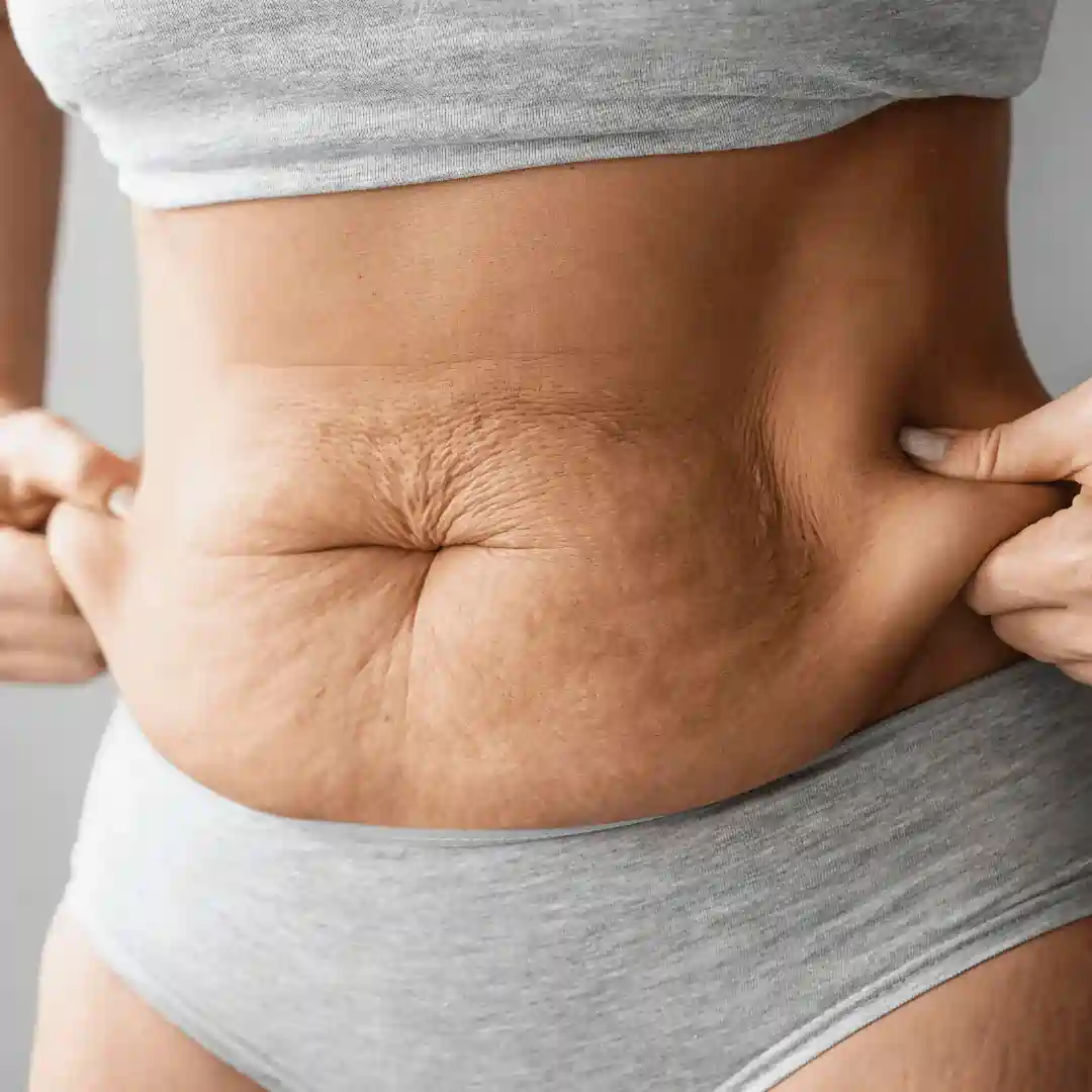 Is It Normal to Have Loose Skin After Pregnancy Dumfries?
